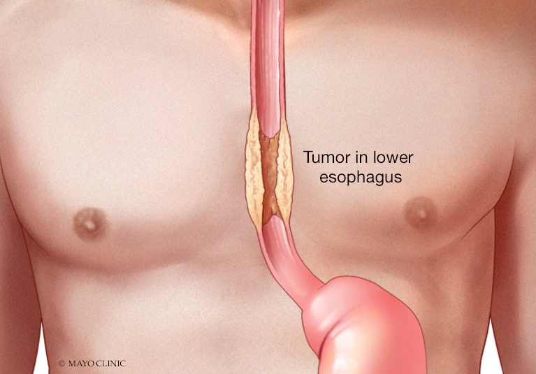 FibroScan Liver Test